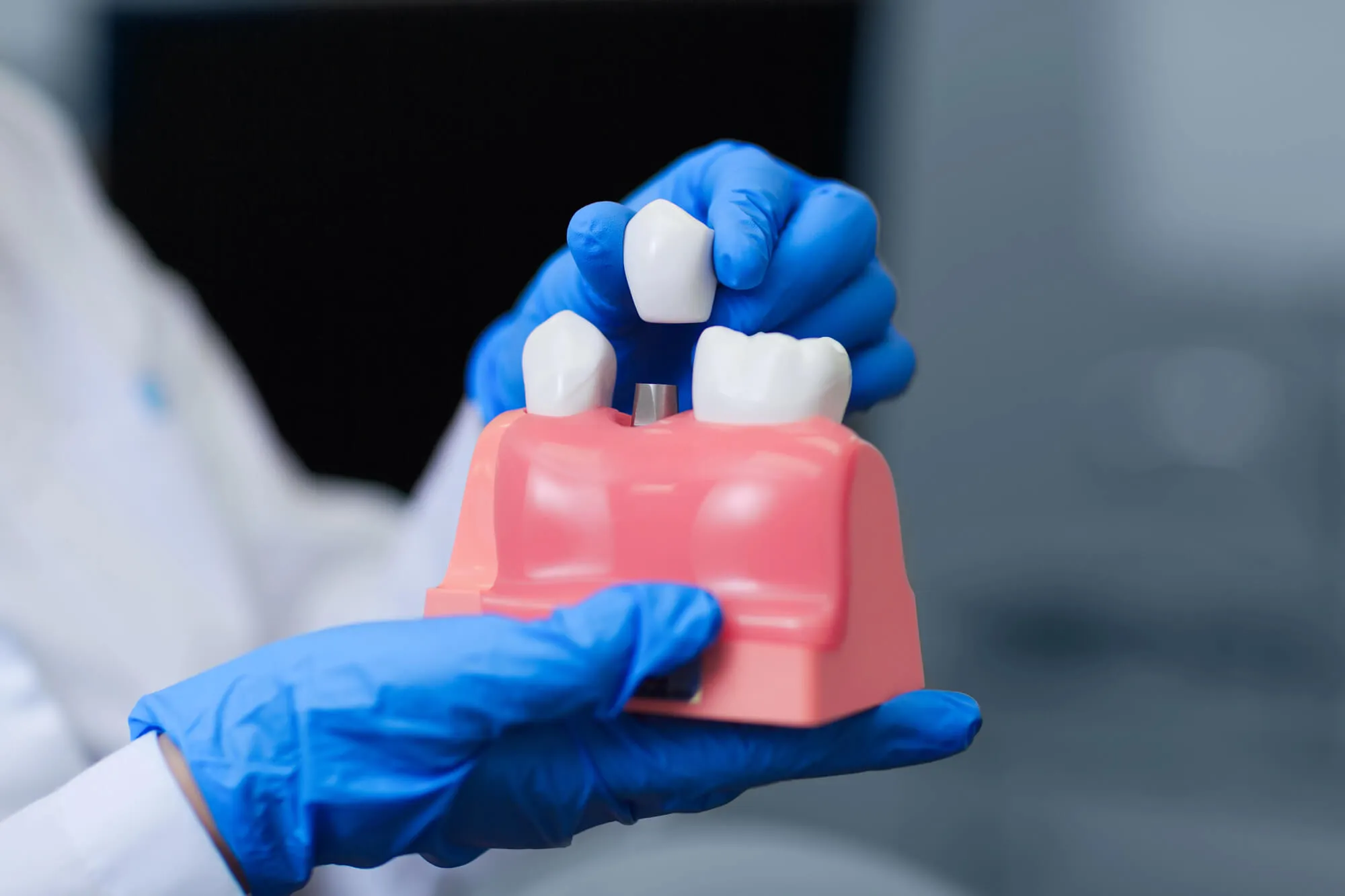 implant dentistry naples model