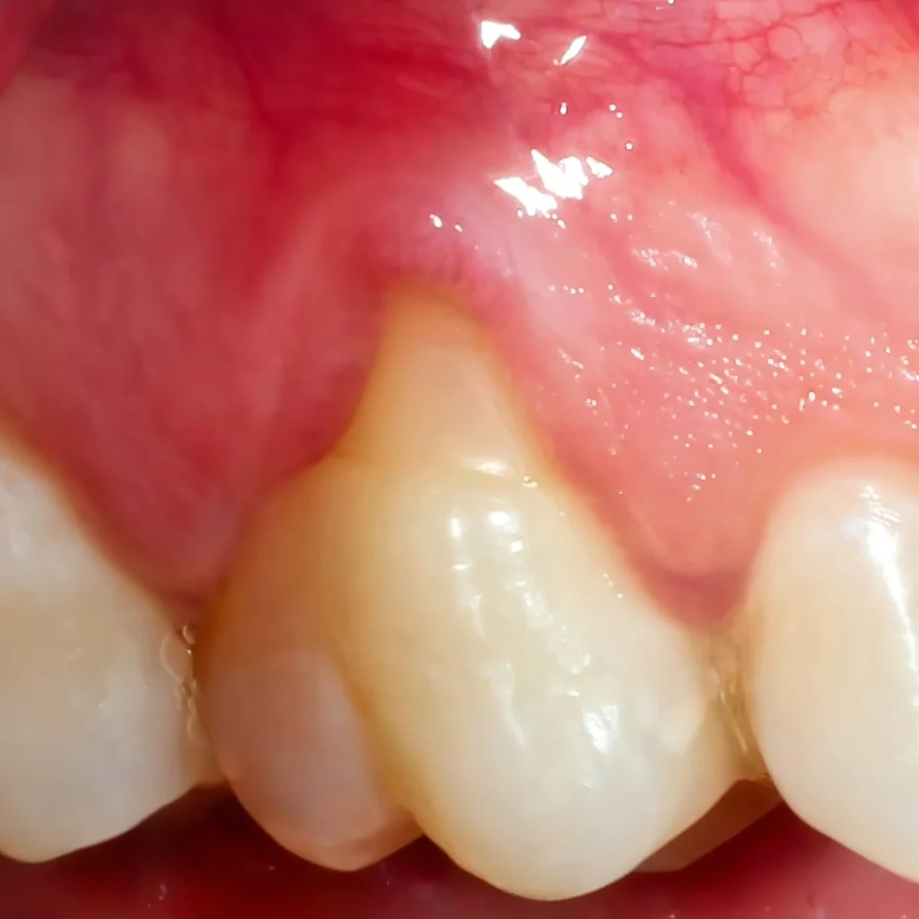 best dentists in naples spots gum recession
