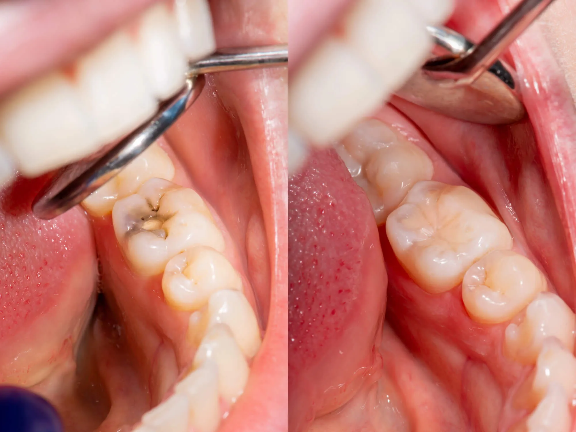 dentist naples checks patient's teeth