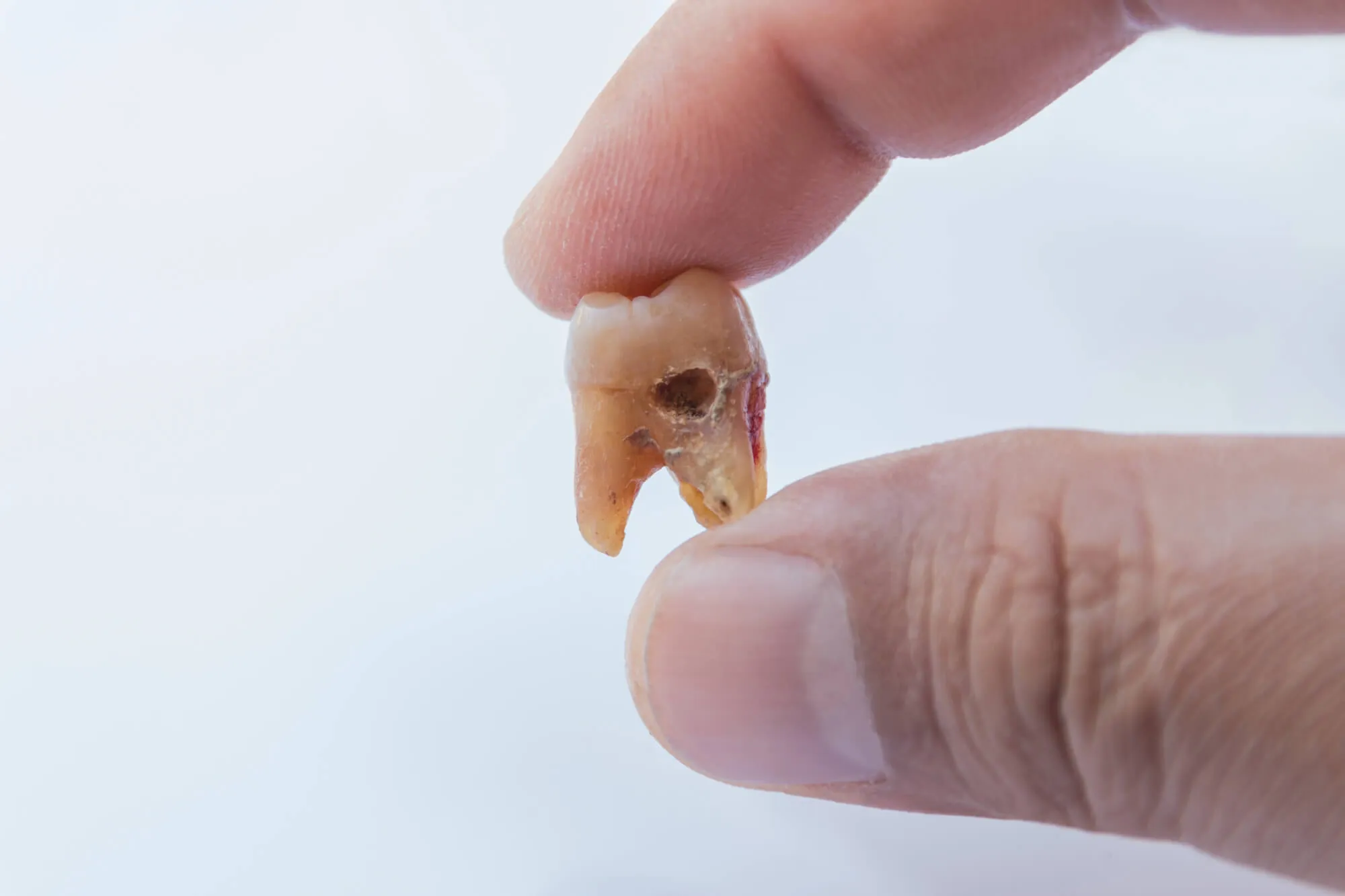 dentist naples holding a decayed tooth